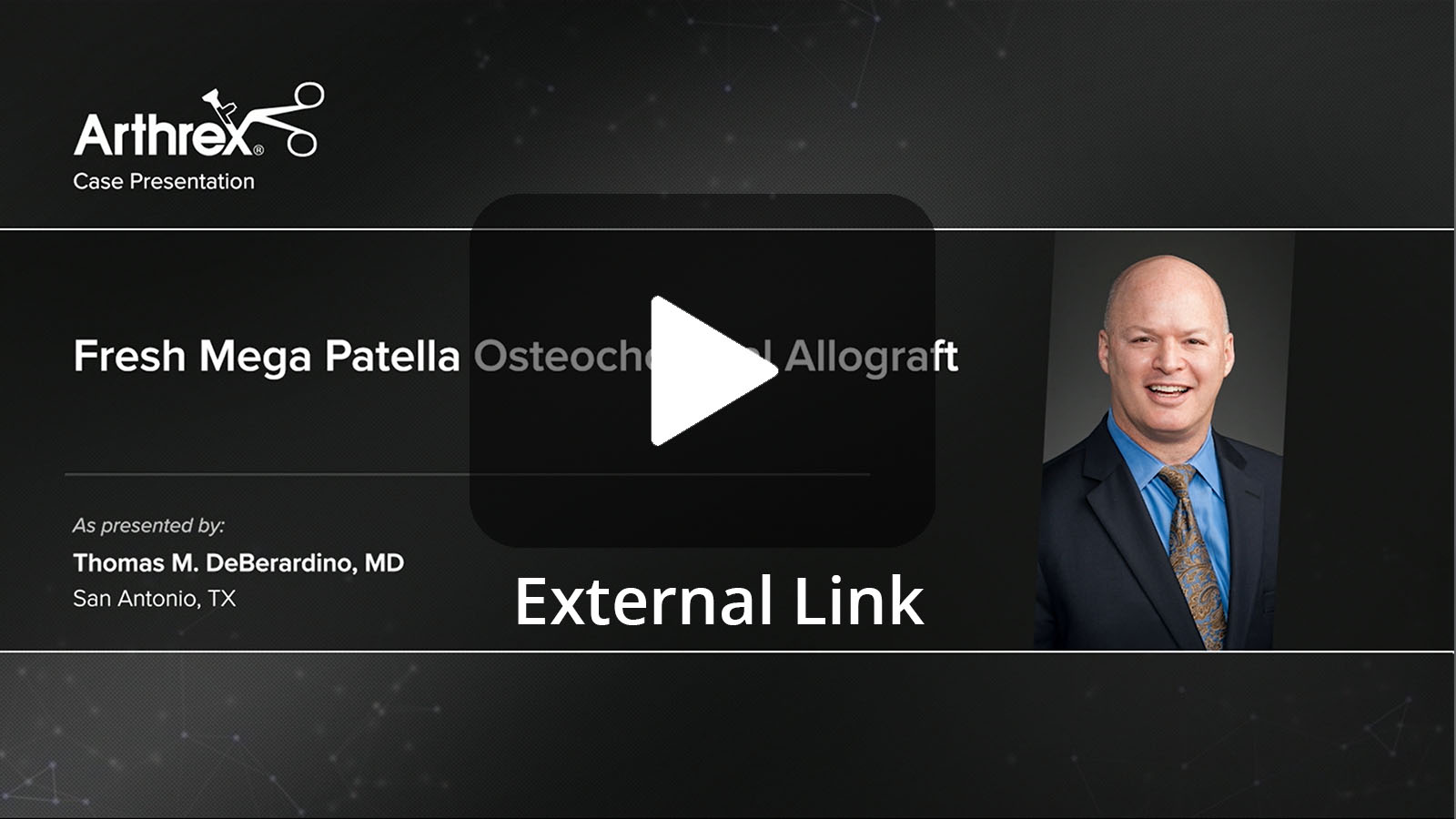 Thomas M. DeBerardino, MD presents a complex case that included an anterior cruciate ligament (ACL) revision, high-tibial osteotomy, medial meniscus allograft transplant, and osteochondral allograft of the patella. (External Link)