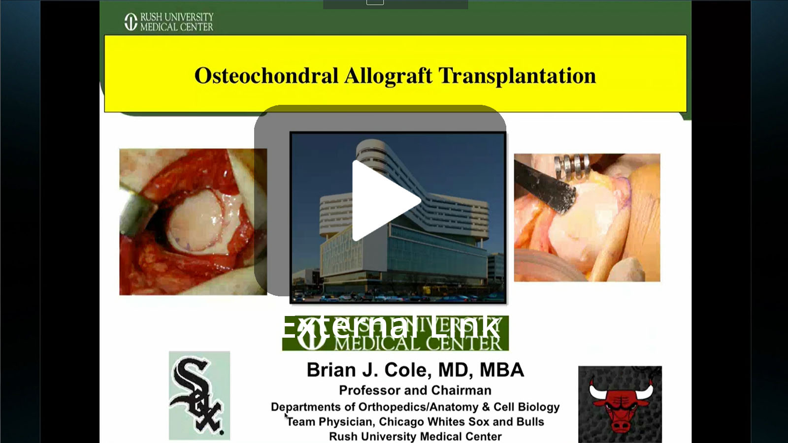 Osteochondral Allograft Transplantation (External Link)