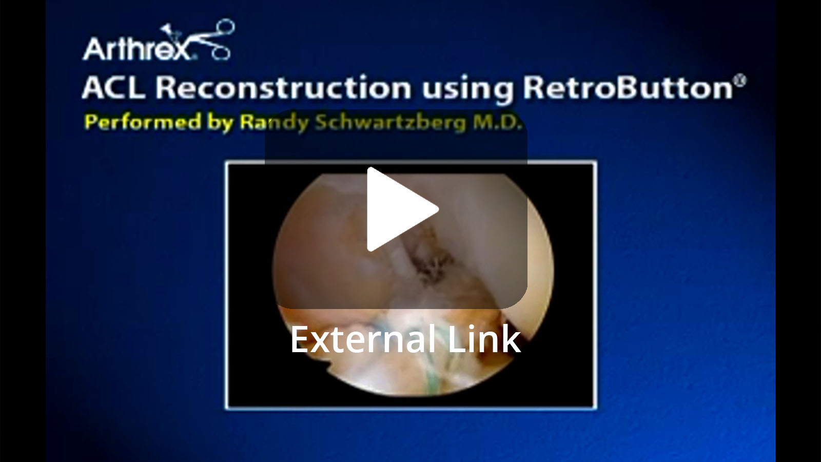 ACL Reconstruction using RetroButton® (External Link)
