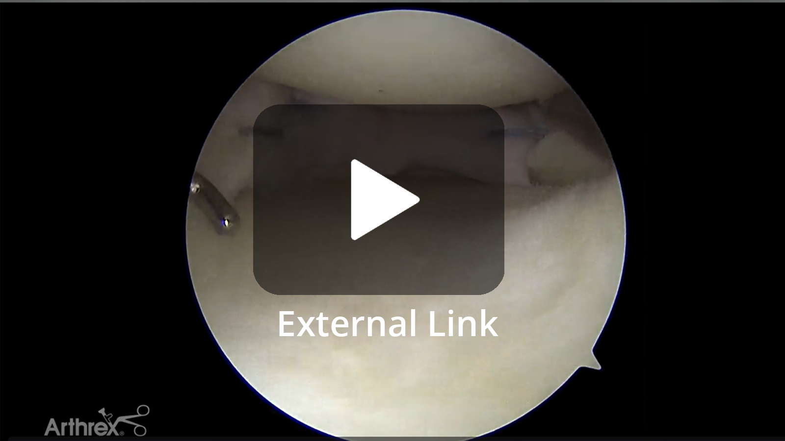 Patrick A. Smith, MD (Columbia, MO), performs a segmental meniscal allograft transplantation procedure. The entire technique and several pearls are included, including defect preparation and measurement as well as graft preparation and fixation. (External Link)
