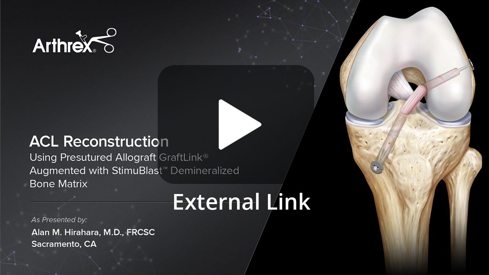ACL Reconstruction using Presutured Allograft GraftLink® Tendon Augmented with StimuBlast® Demineralized Bone Matrix (External Link)