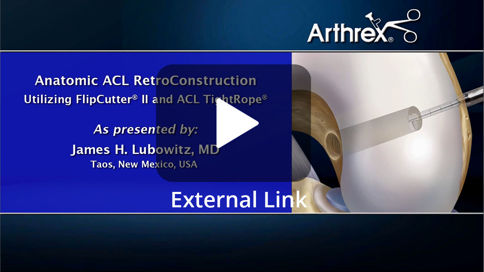 Anatomic ACL RetroConstruction™ Utilizing FlipCutter® II and ACL TightRope® sutures (External Link)