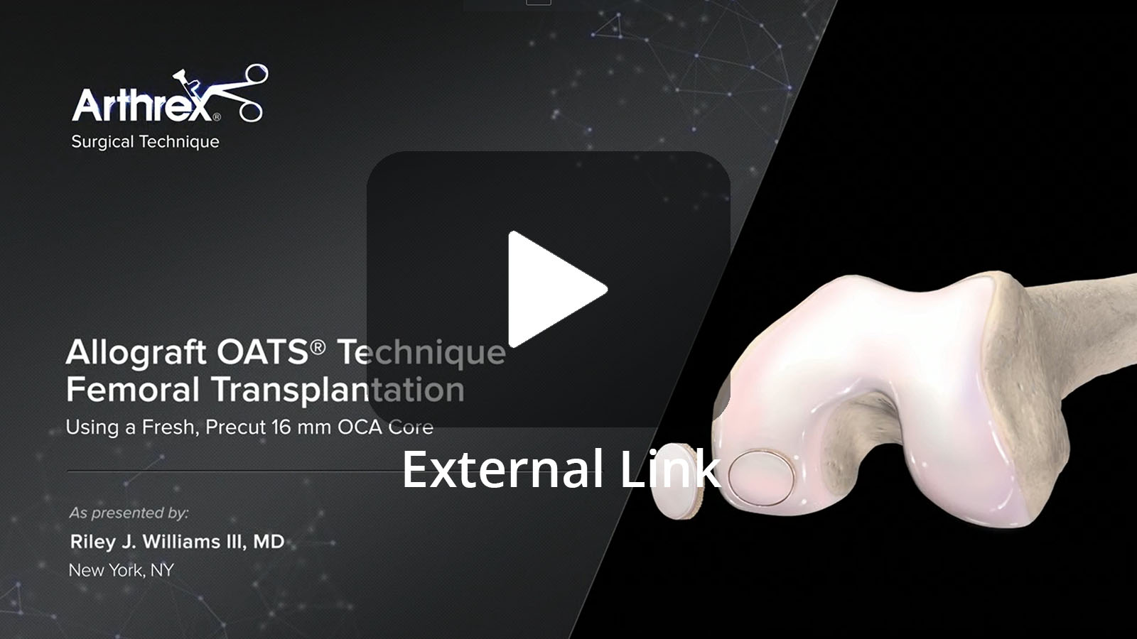 Allograft OATS® Technique Femoral Transplantation Using a Precut 16 mm OCA Core (External Link)