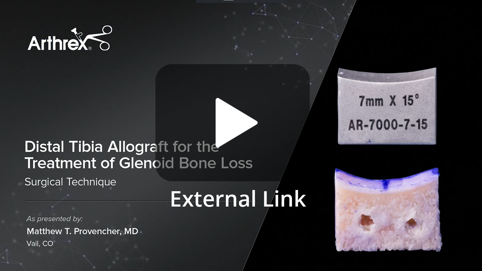 Matthew T. Provencher, MD demonstrates the use of a distal tibia allograft for anterior glenoid reconstruction when faced with significant bone loss. He uses the Distal Tibia Allograft Workstation which helps to accurately template, prepare and fixate the desired bone block. (External Link)