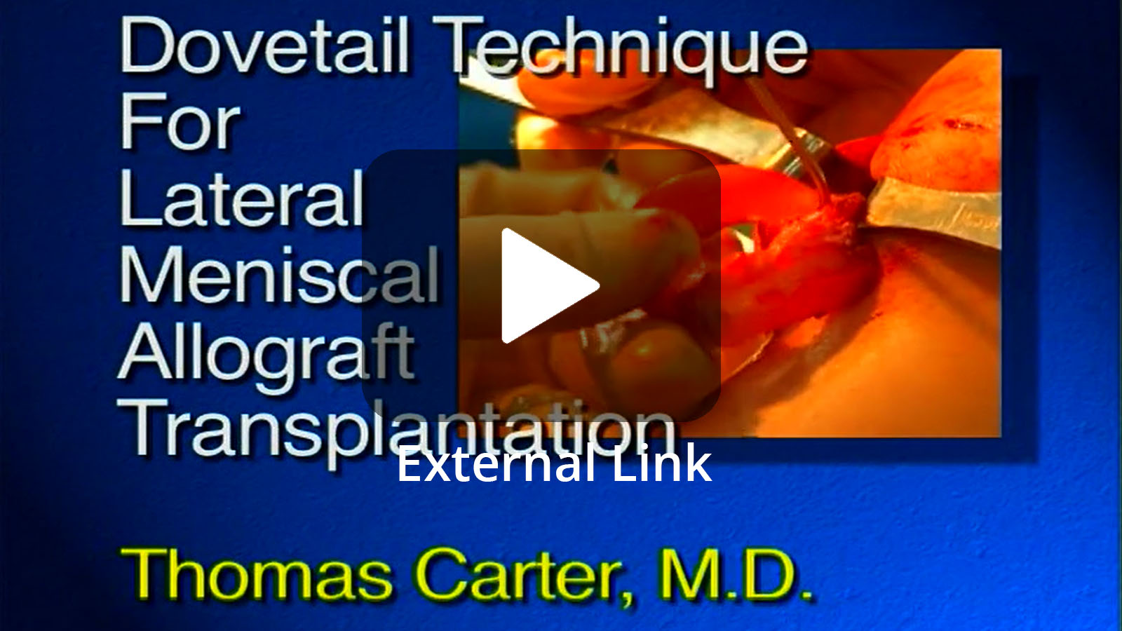 Dovetail Technique for Lateral Meniscal Allograft Transplantation (External Link)