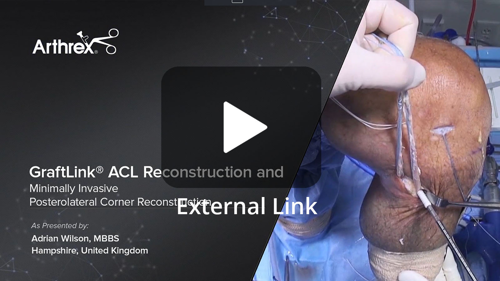 Pediatric ACL Reconstruction using the GraftLink® All-Epiphyseal Technique (External Link)