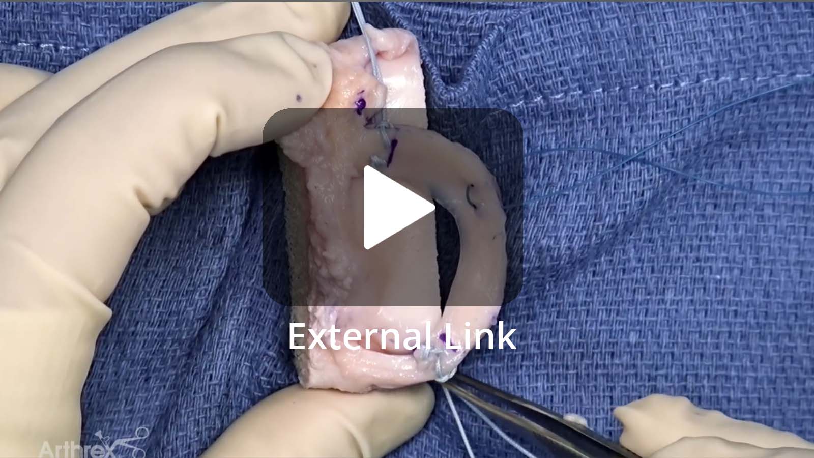 James L. Carey, MD, MPH (Philadelphia, PA), demonstrates a soft−tissue-only meniscal allograft transplantation and provides a full overview of the technique, from preparation of the recipient site and allograft through various fixation options for securing the graft.  (External Link)