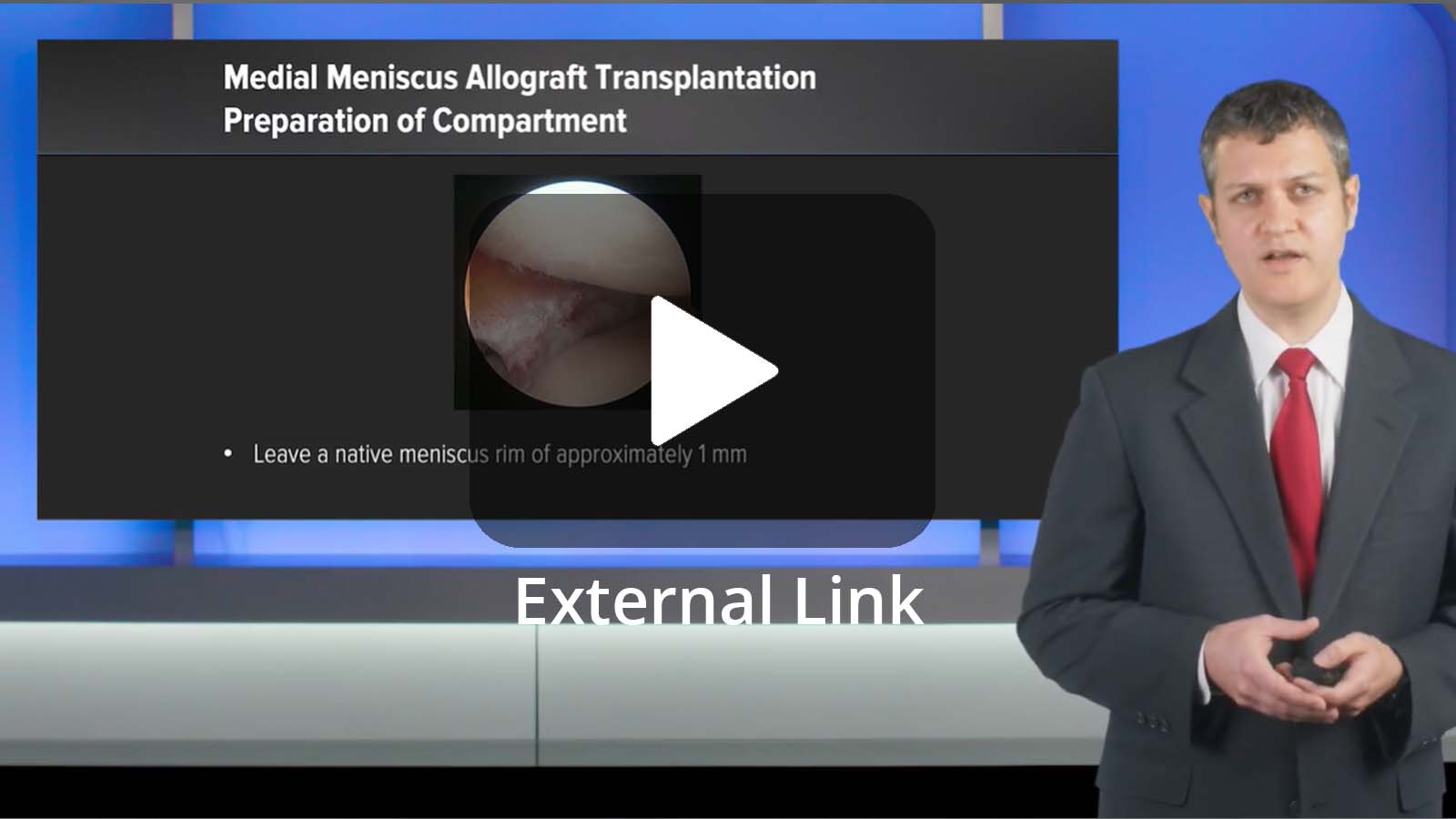 James L. Carey, MD, MPH (Philadelphia, PA), presents a case of meniscal allograft transplantation using an all-soft-tissue technique. Dr. Carey shares various technical pearls and discusses the importance of primary and secondary graft stability.  (External Link)