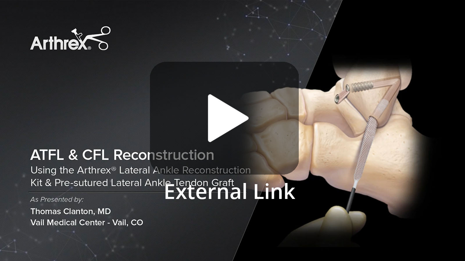 Thomas Clanton, MD, (Vail, CO) demonstrates how to perform a Lateral Ankle Reconstruction of the ATFL and CFL utilizing the Arthrex Lateral Ankle Reconstruction System in conjunction with the Pre-Sutured Lateral Ankle Tendon Allograft. (External Link)