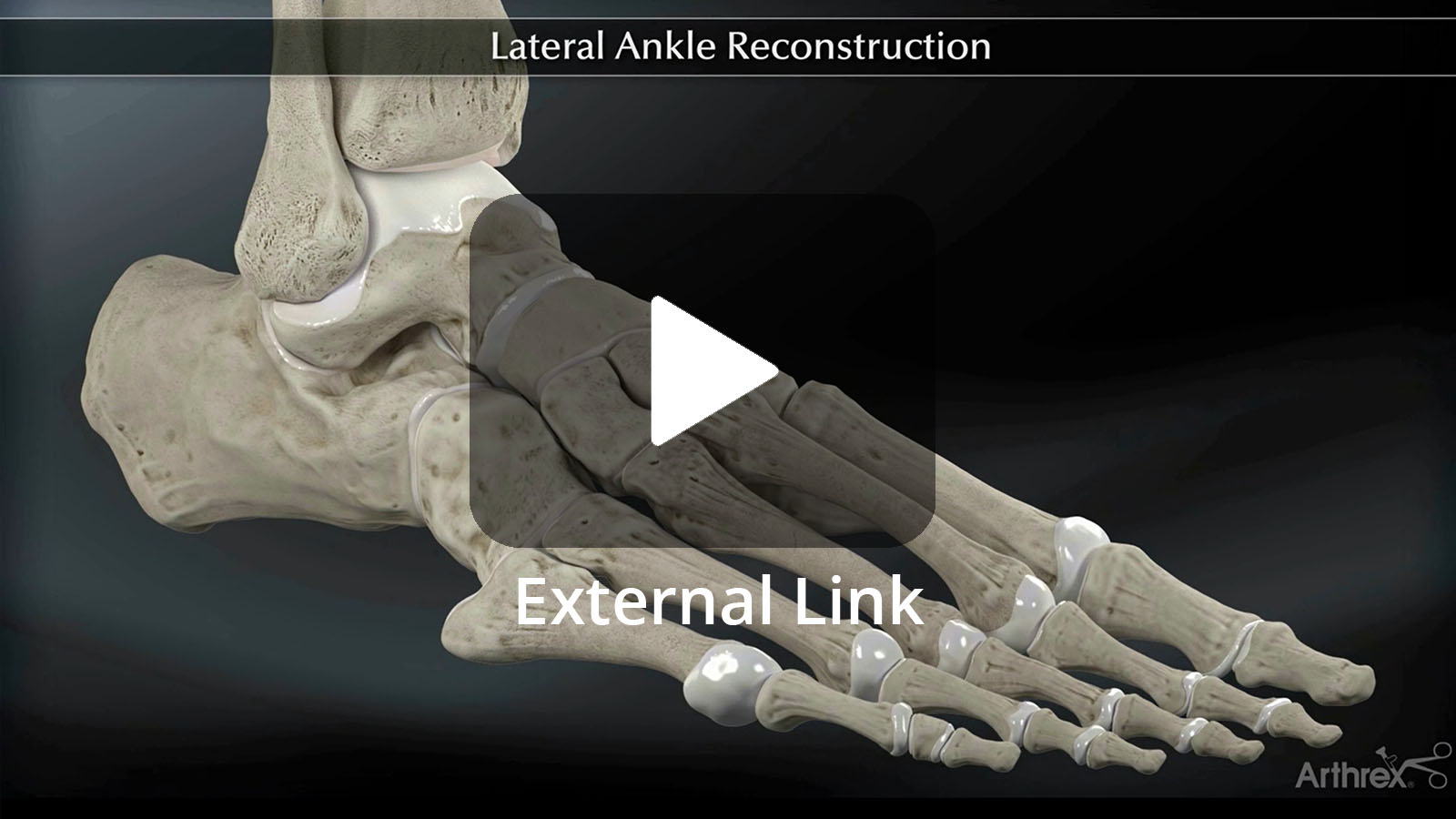 Lateral Ankle Reconstruction (animated) (External Link)