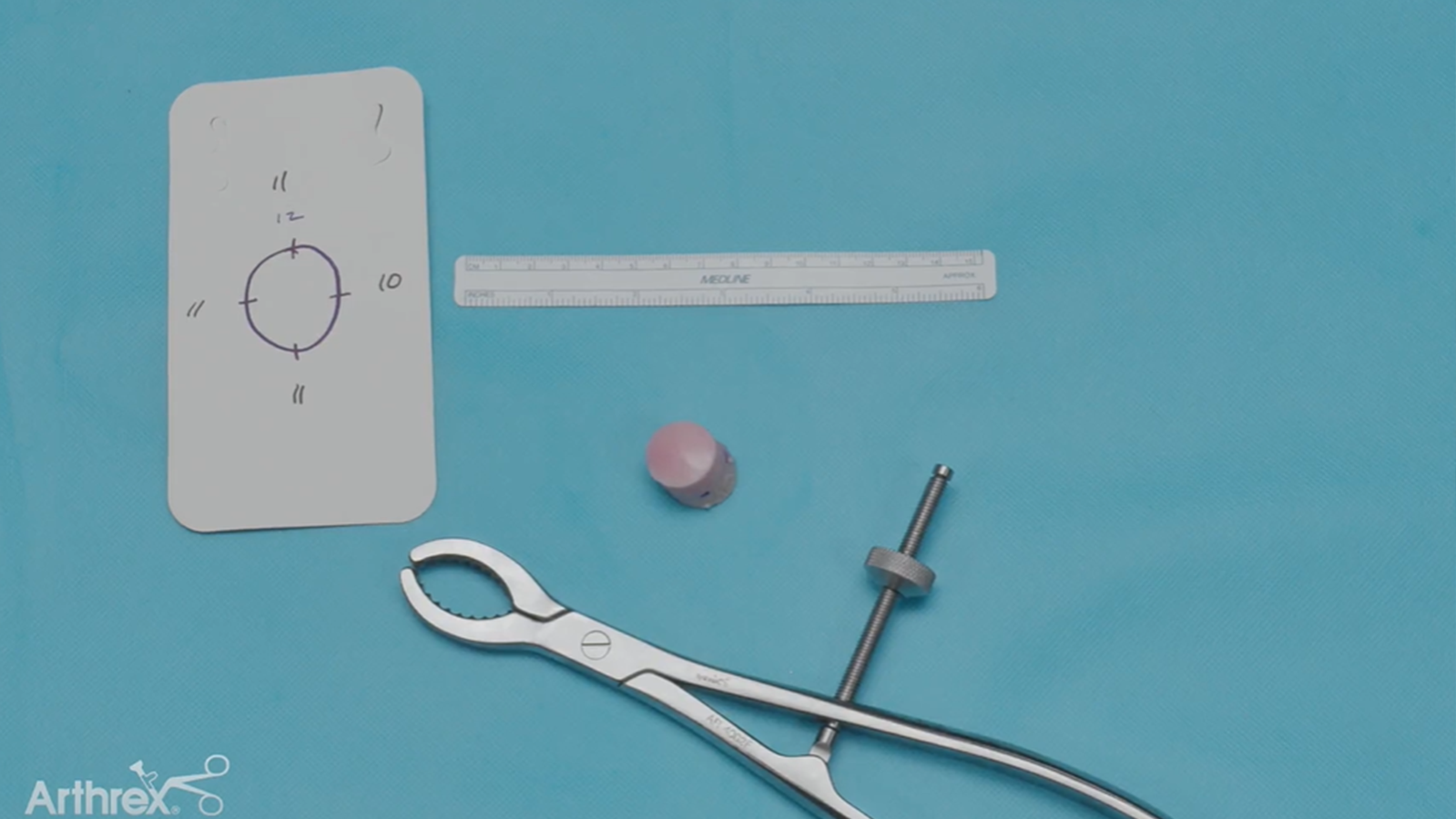 A demonstration of the allograft OATS® technique for treatment of a medial femoral condyle osteochondral defect. (External Link)