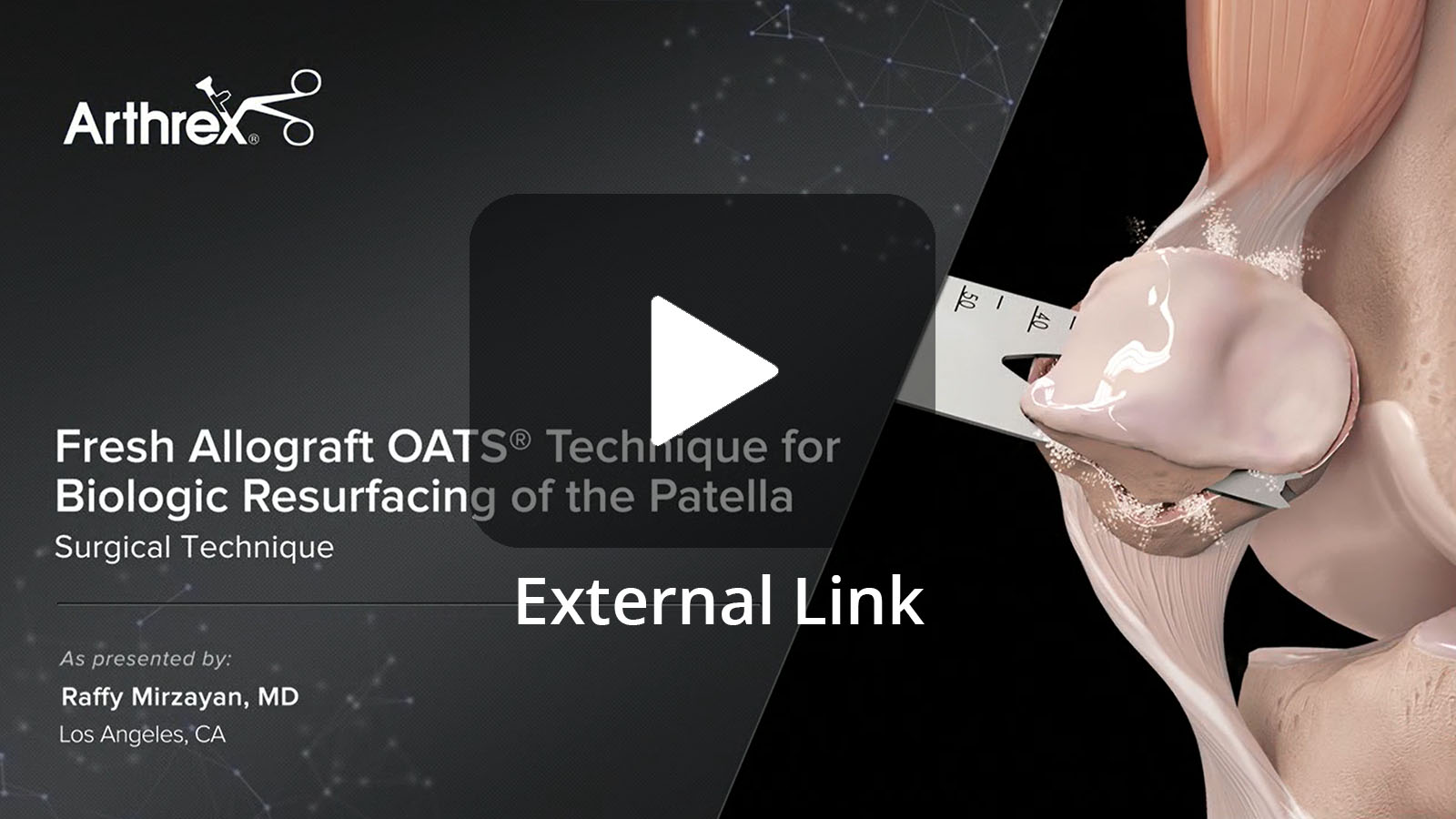 Raffy Mirzayan, MD, (Los Angeles, CA) performs a complete resurfacing of the patella with a osteochondral allograft. Dr. Mirzayan includes multiple technical pearls for donor and recipient side preparations. (External Link)