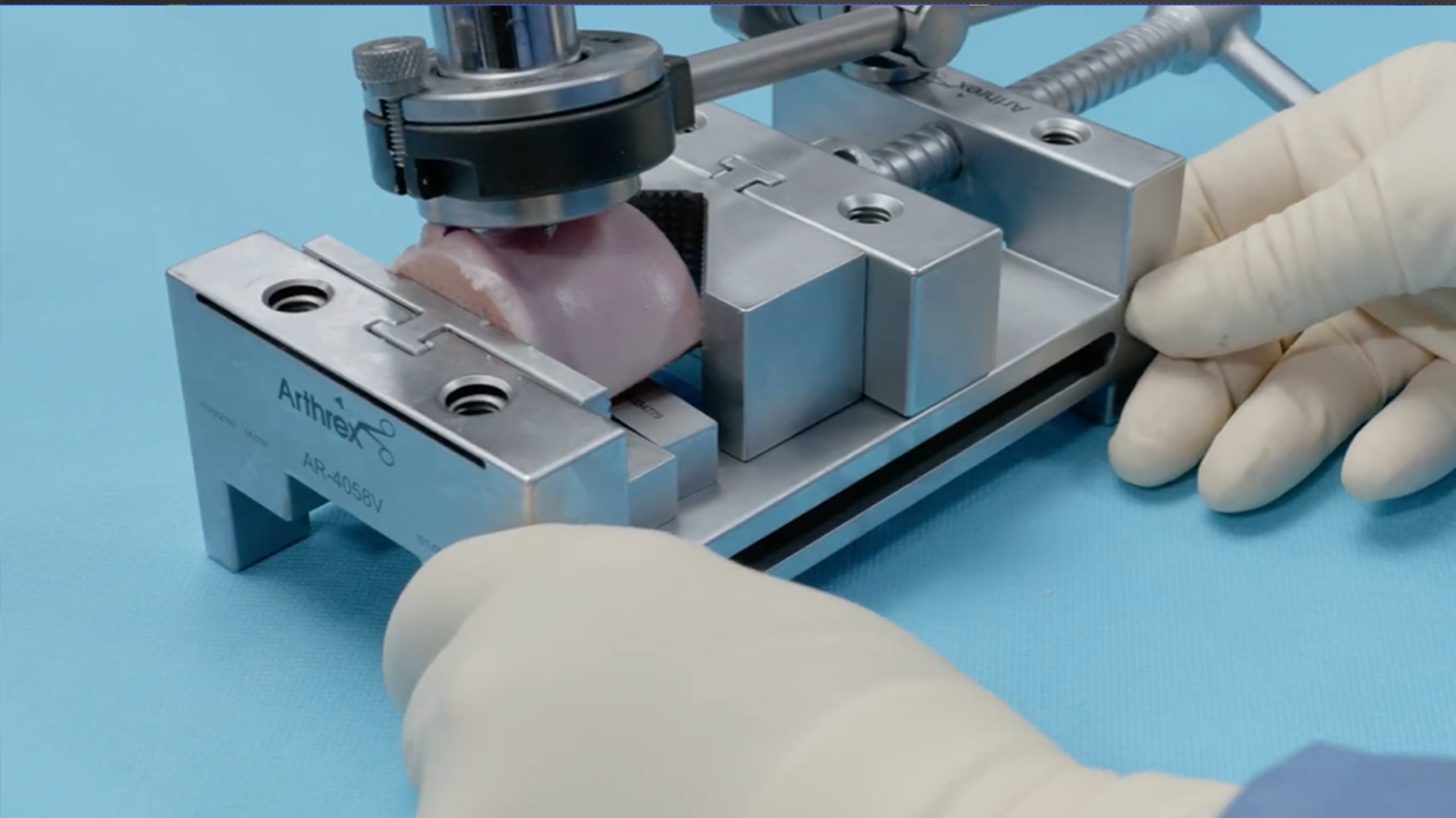 Brian J. Cole, MD, MBA., demonstrates a trochlear osteochondral allograft procedure. Dr. Cole highlights several features of the instrumentation and workstation that help surgeons prepare donor and recipient surgical sites. (External Link)